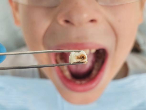 Best Walk-In Emergency Dental Services in Monticello, IL